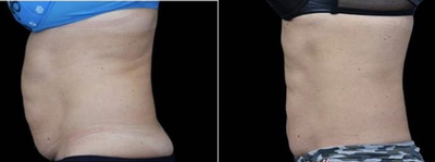 Emsculpt before and after photo
