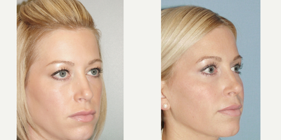 Eyelid Surgery before and after photo