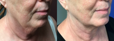 Nonsurgical Neck Lift before and after photo
