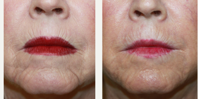 Vollure before and after photo