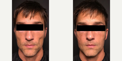 Bellafill before and after photo