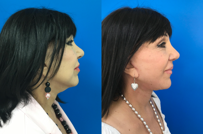 Deep Plane Facelift before and after photo