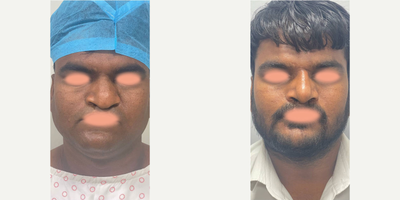 Rhinoplasty before and after photo