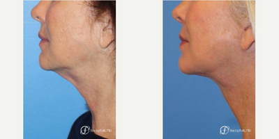 Facelift before and after photo