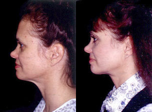 Neck Lift before and after photo