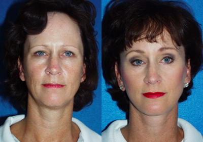Facelift before and after photo