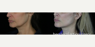 Neck Lift before and after photo