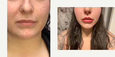 Restylane before and after photo