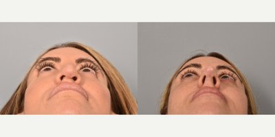 Revision Rhinoplasty before and after photo