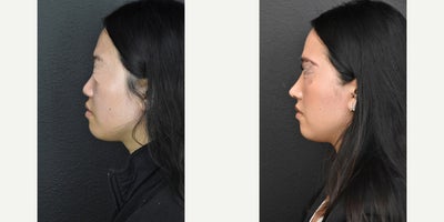 Asian Rhinoplasty before and after photo
