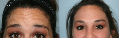 Botox before and after photo