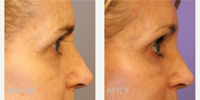 Brow Lift before and after photo