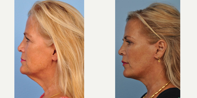 Facelift before and after photo