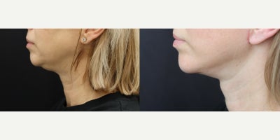 Facelift before and after photo