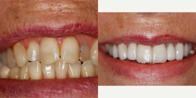 Lumineers before and after photo