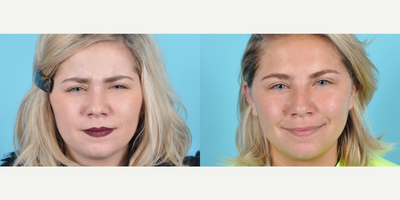 Botox before and after photo
