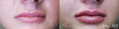 Dermal Fillers before and after photo