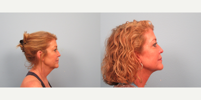 Nonsurgical Facelift before and after photo