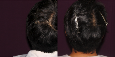 PRP for Hair Loss before and after photo