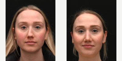 Rhinoplasty before and after photo