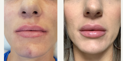 Volbella before and after photo