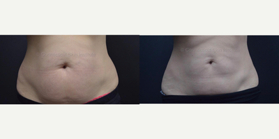 CoolSculpting before and after photo