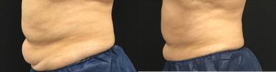 CoolSculpting before and after photo
