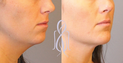 Dermal Fillers before and after photo