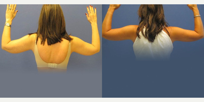 Liposuction before and after photo