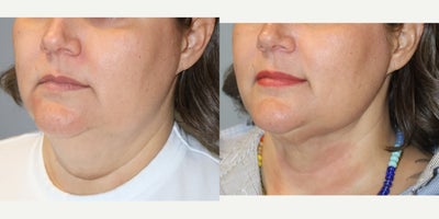 Liposuction before and after photo