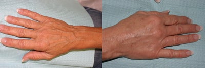 Sclerotherapy before and after photo