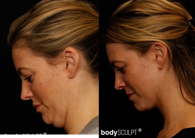 Liposuction before and after photo