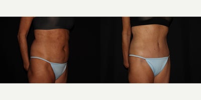 Tummy Tuck before and after photo