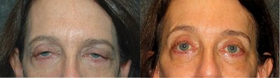 Brow Lift before and after photo