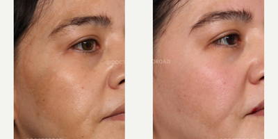 CO2 Laser before and after photo
