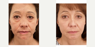 Eyelid Surgery before and after photo