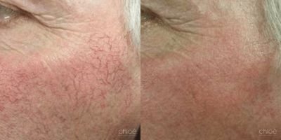 Laser Resurfacing before and after photo