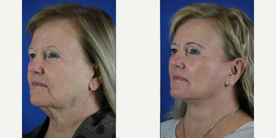 Deep Plane Facelift before and after photo