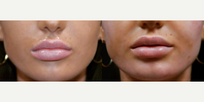 Lip Fillers before and after photo