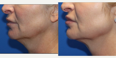 SculpSure before and after photo