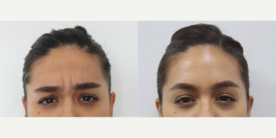 Botox before and after photo