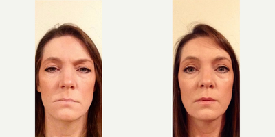 Eyelid Surgery before and after photo