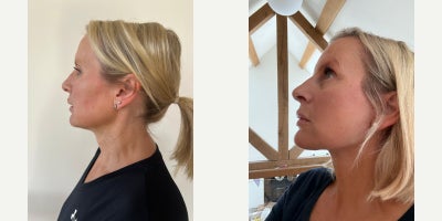 Facelift before and after photo
