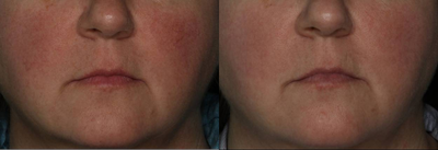Laser Resurfacing before and after photo