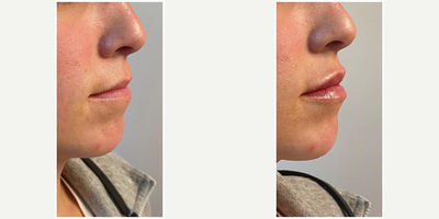 Lip Fillers before and after photo