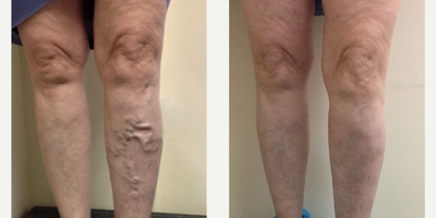 Sclerotherapy before and after photo