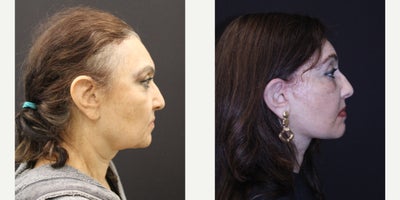 Deep Plane Facelift before and after photo