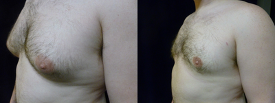 Gynecomastia Surgery before and after photo