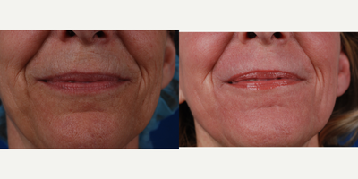 Laser Resurfacing before and after photo
