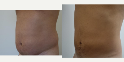 Liposuction before and after photo